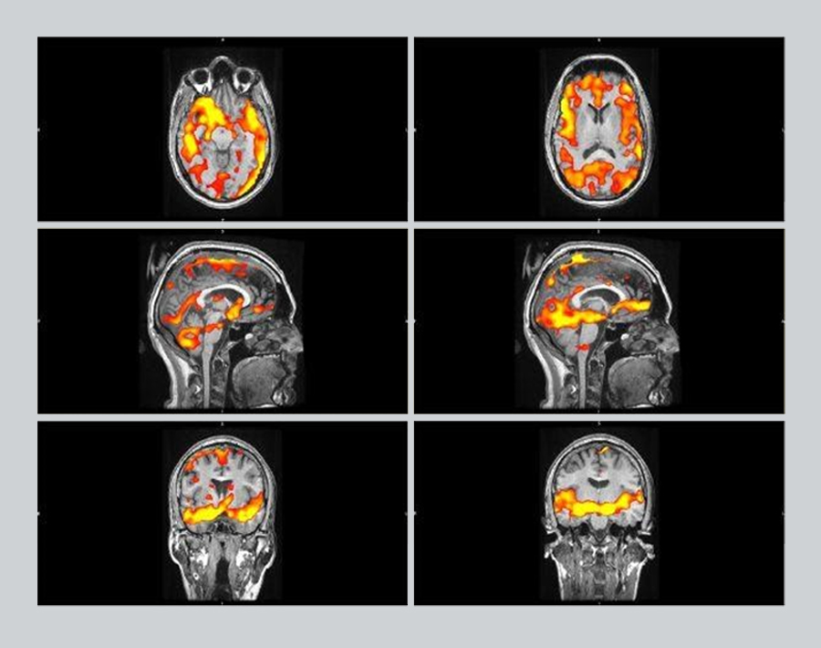 fmri_PTSD