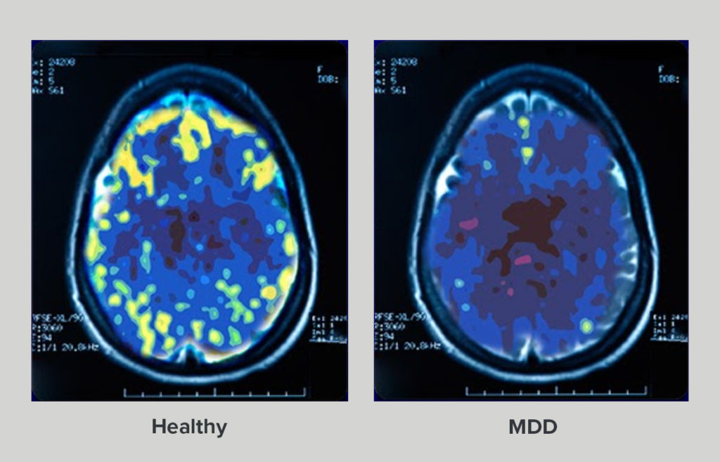 fmri_mdd